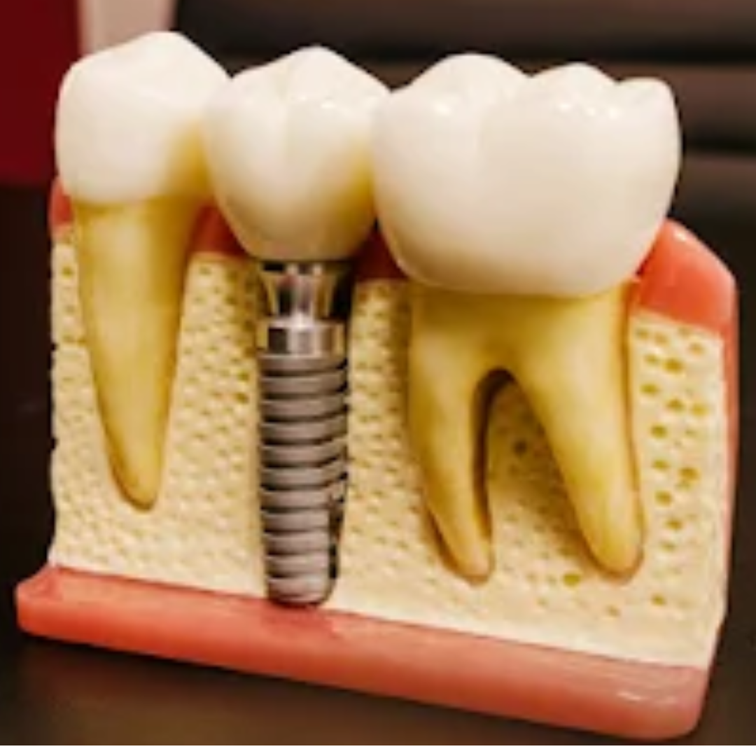 implante dentario