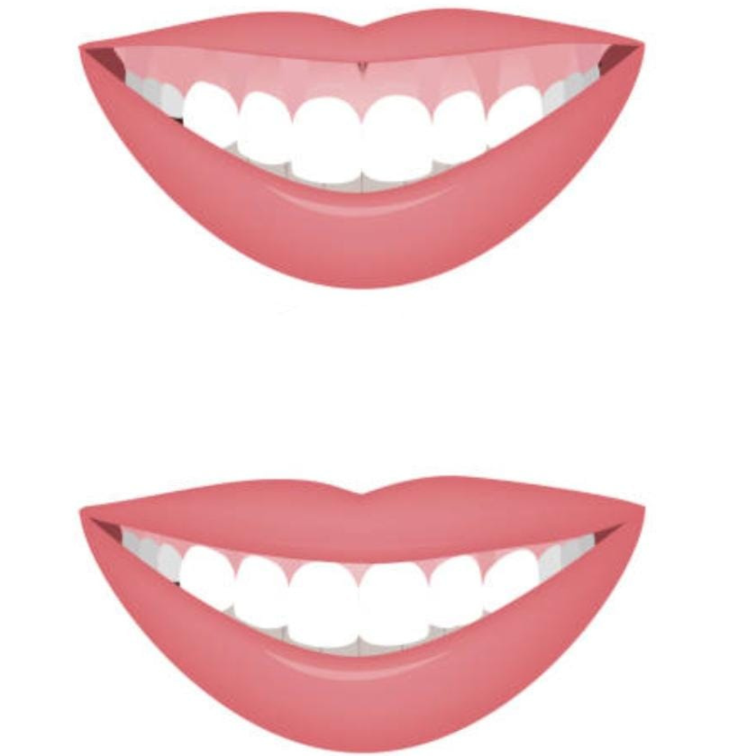 reposicionamento labial